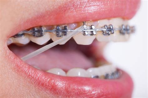 underbite metal bracket rubber bands not braces|braces for underbite repair.